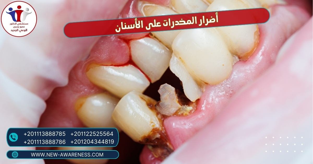 أضرار المخدرات على الأسنان